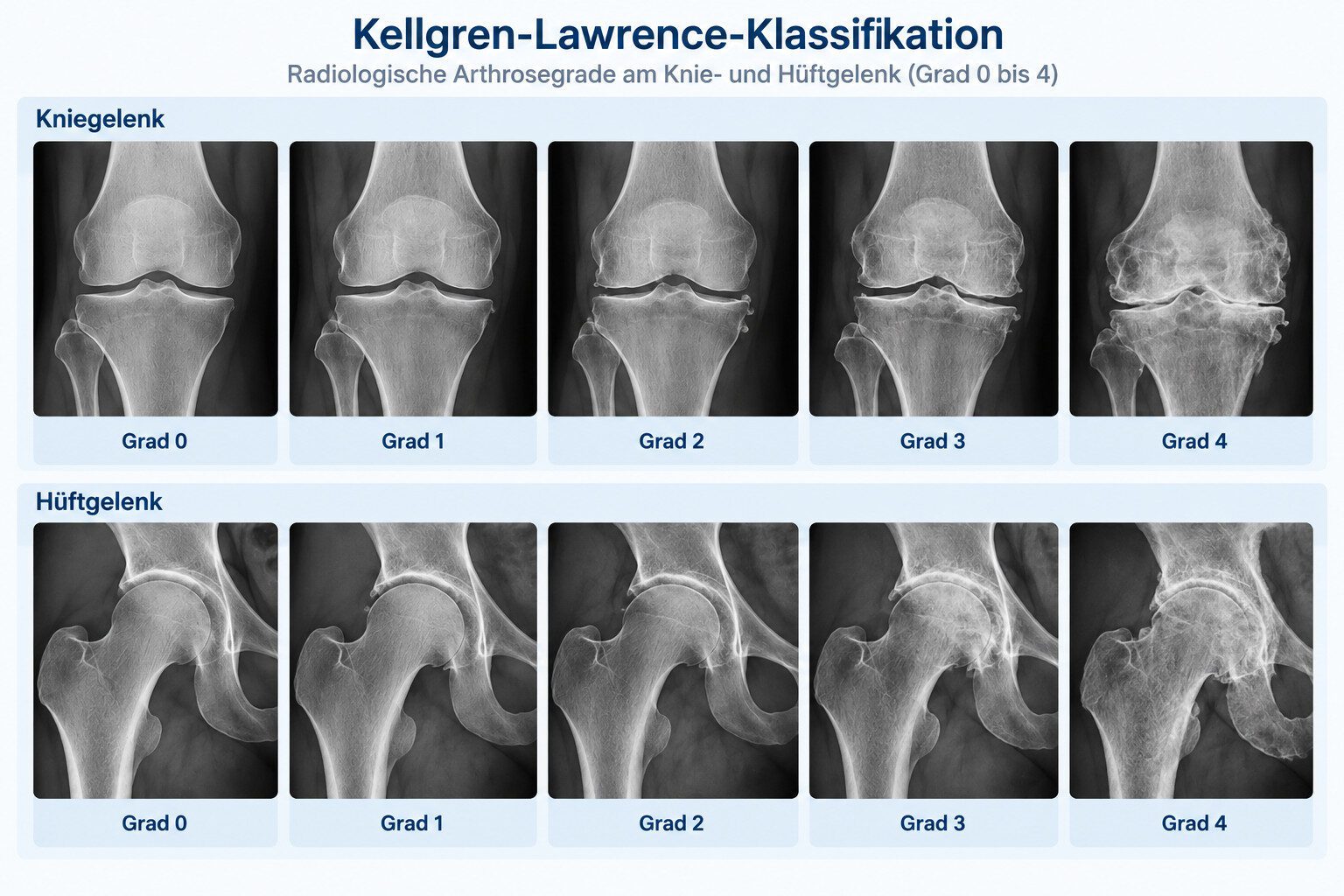 Kellgren-Lawrence-Klassifikation: Arthrosegrade 0 bis 4 an Knie und Hüfte